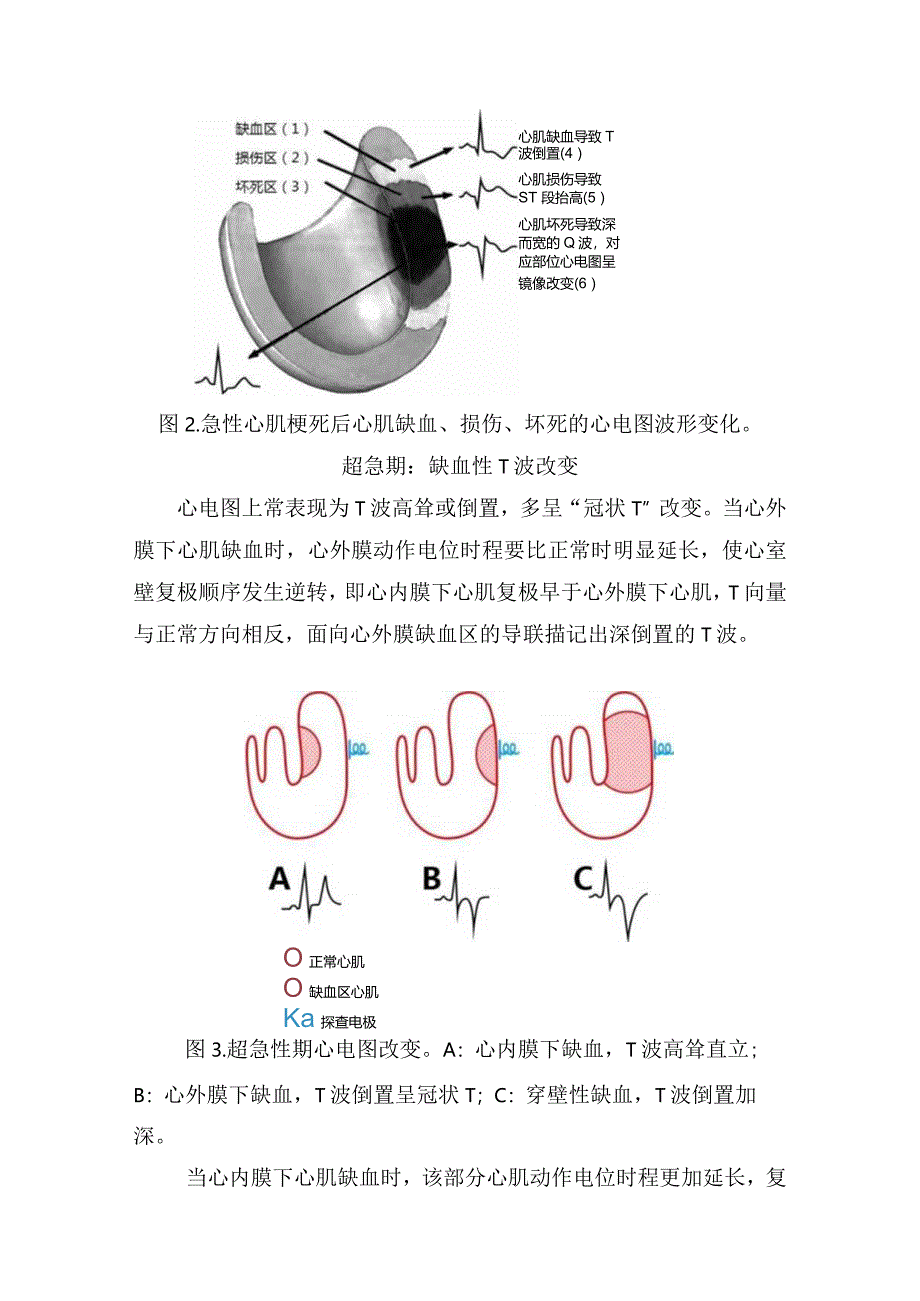 临床急性心梗心电图、阶段特点及异常Q波诊断与鉴别诊断.docx_第2页