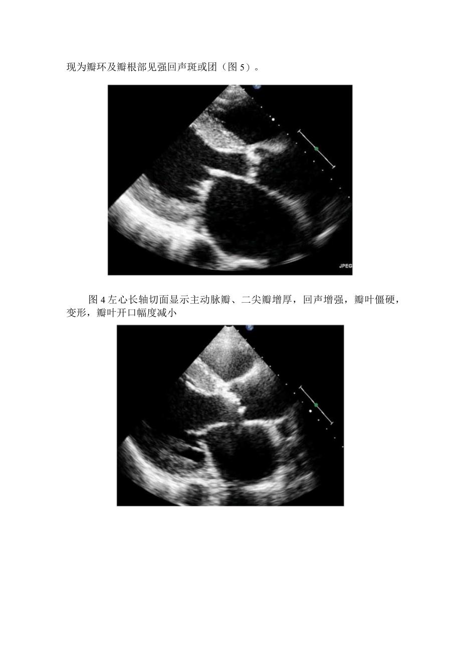 临床主动脉瓣狭窄超声诊断要点.docx_第3页