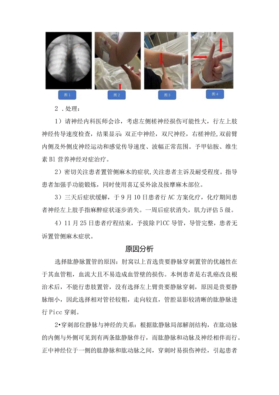 临床PICC置管致手指麻木病例、原因分析、预防处理及护理体会.docx_第2页