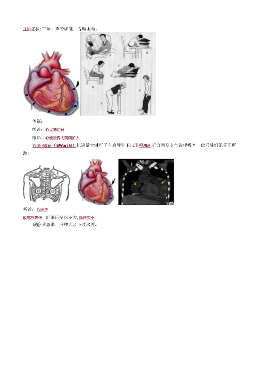 心血管内科主治医师资格笔试专业实践能力考点解析 (12)：心包疾病.docx_第2页