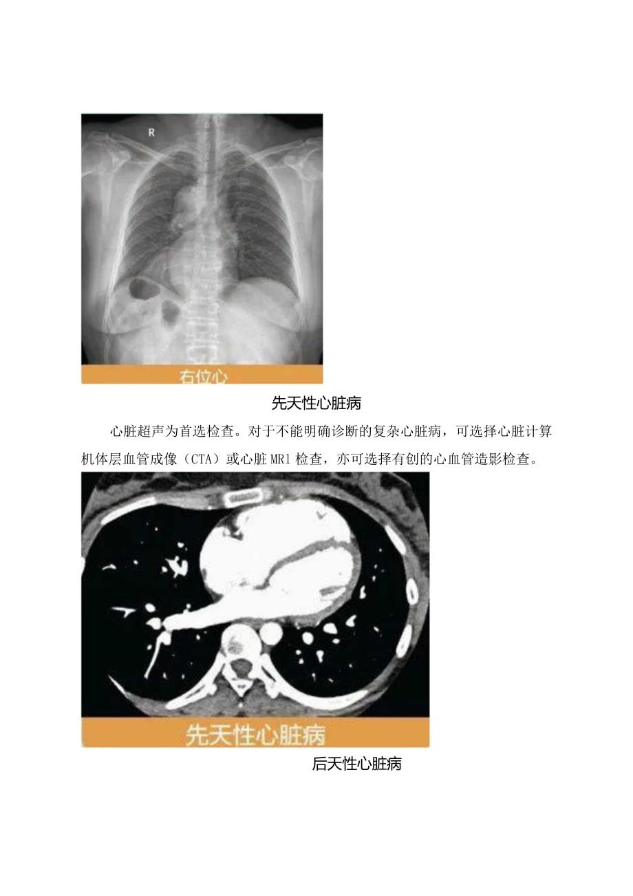 先天性心脏、大血管位置和连接异常、先天性心脏病、后天性心脏病、心包疾病、大血管病变等循环系统病变影像学检查选择要点.docx_第2页