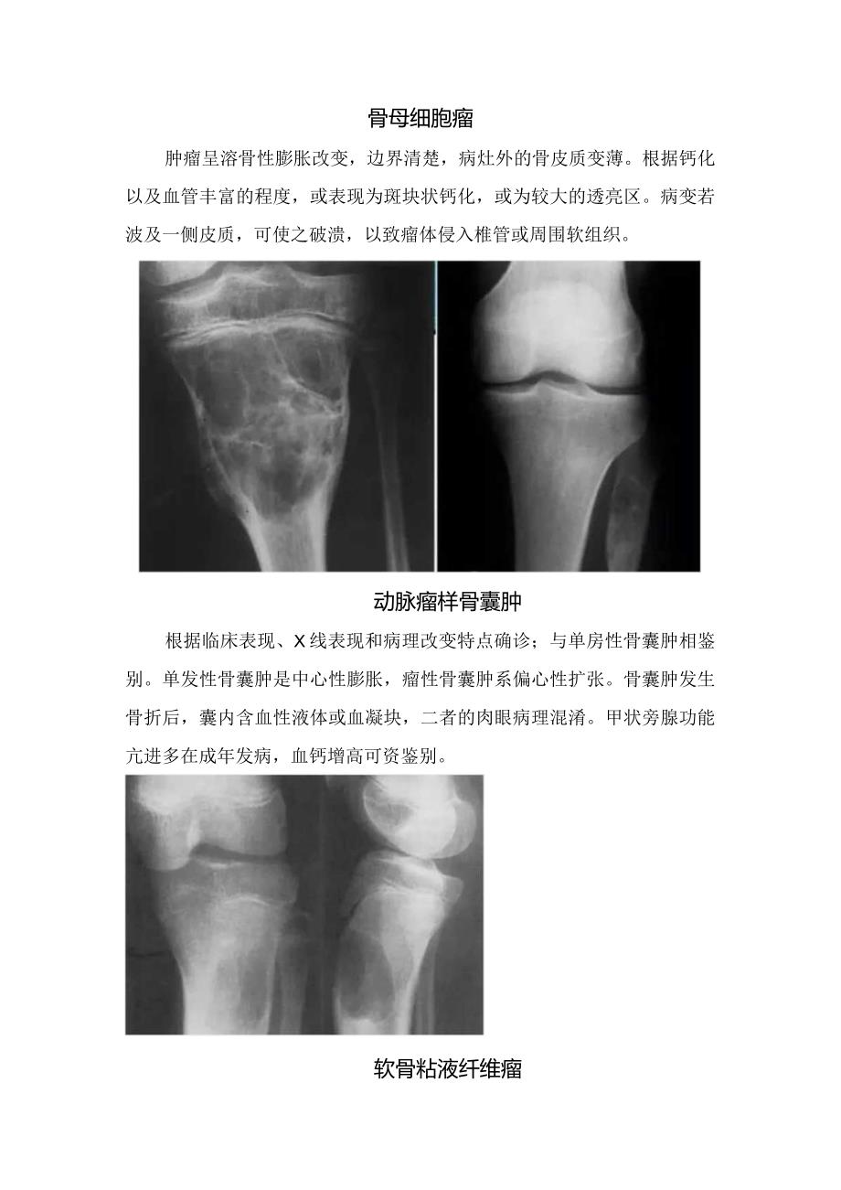 骨样骨瘤、骨母细胞瘤、软骨粘液纤维瘤、软骨母细胞、骨膜软骨瘤、尤文氏肉瘤等骨膜反应的肿瘤临床表现及影像学特征.docx_第2页