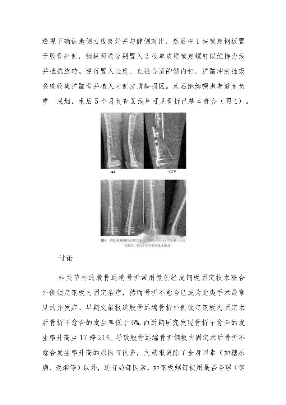 骨外科股骨远端骨折内固定术后顽固性骨折不愈合病例分析专题报告.docx_第3页