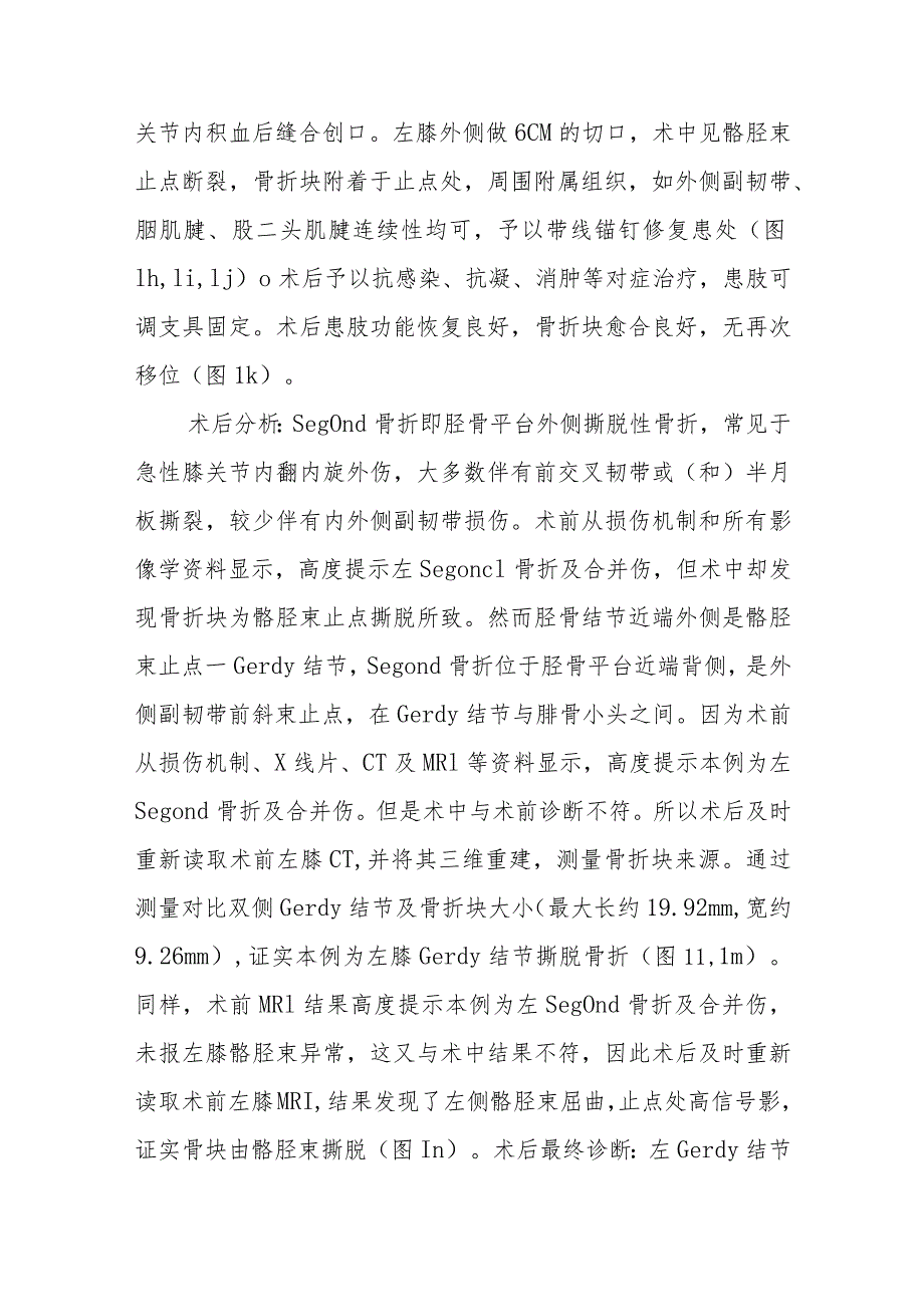 骨外科极易误诊为胫骨平台外侧撕脱性骨折病例分析专题报告.docx_第3页