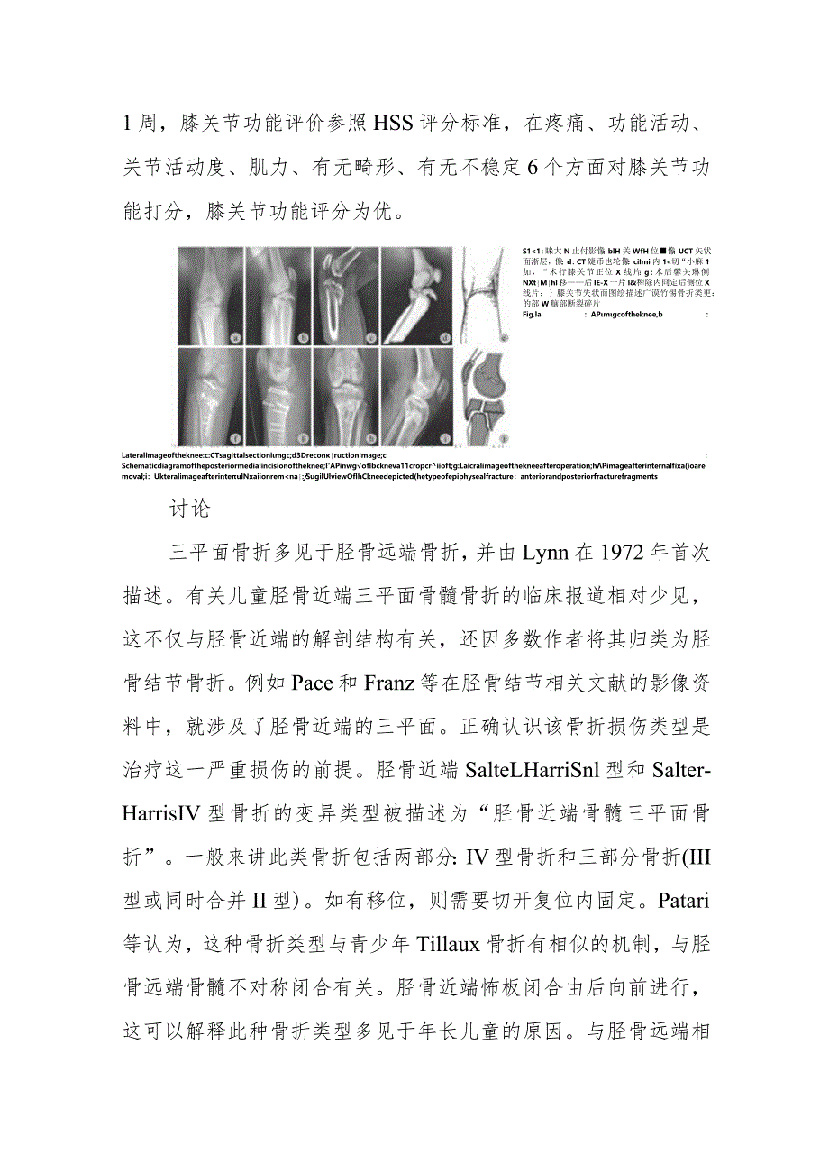 骨外科儿童胫骨近端三平面骨骺骨折病例分析专题报告.docx_第3页