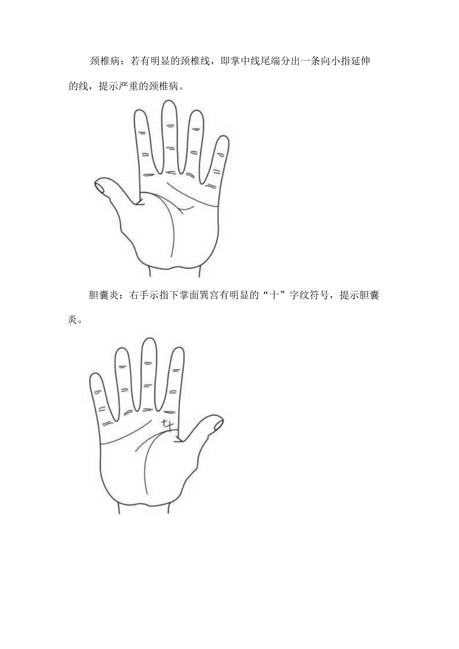 脑卒中、低血压、颈椎病、胆囊炎、胃炎等手诊医学表现.docx_第2页