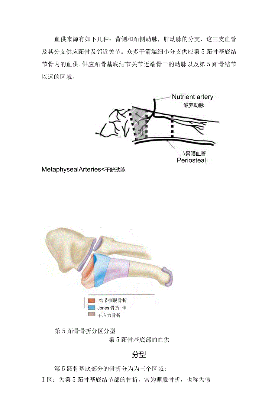 足部第5跖骨基底骨折分型、诊断、治疗及注意事项.docx_第2页