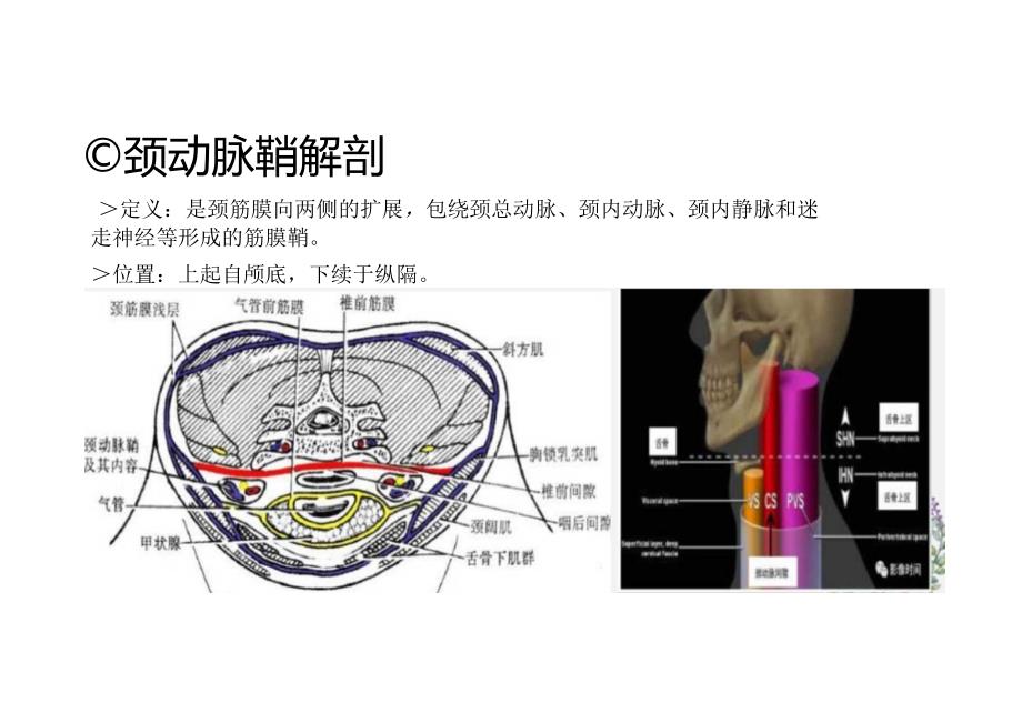 颈动脉区神经鞘瘤的影像诊断与鉴别诊断.docx_第2页