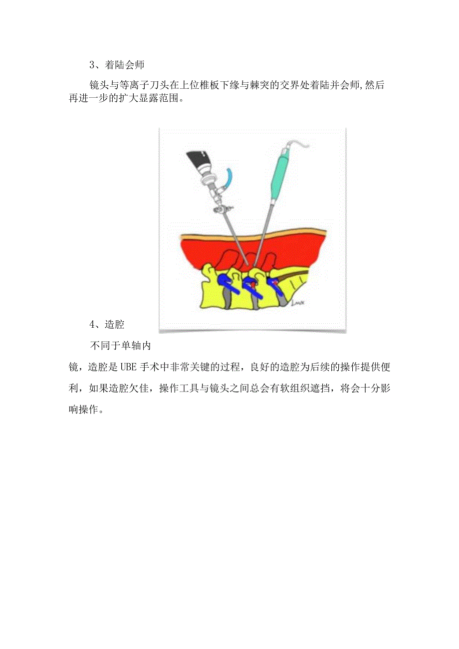 UBE手术入门改良LOVE手术要点.docx_第3页