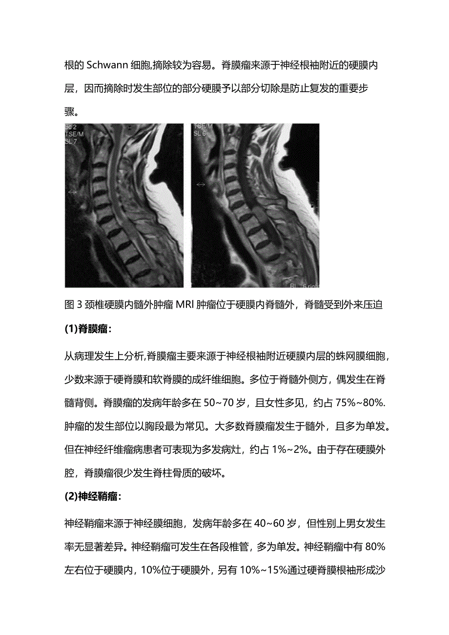 2024脊髓肿瘤的分型及诊疗策略.docx_第3页