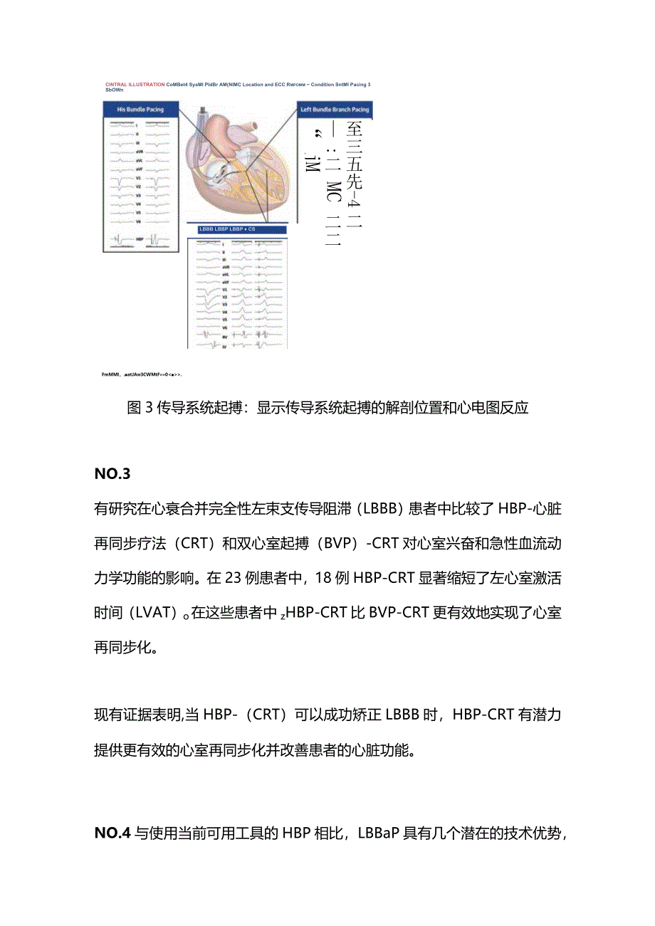 心脏传导系统起搏领域最新研究进展2024.docx_第3页