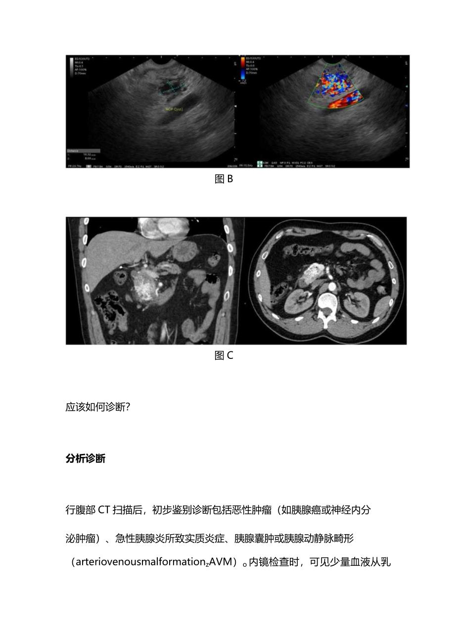 2024急性胰腺炎的罕见原因诊断.docx_第2页