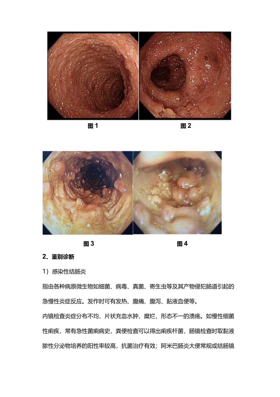 2024炎症性肠病鉴别诊断.docx_第2页