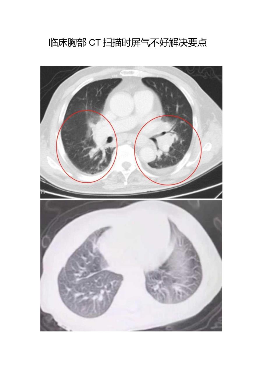 临床胸部CT扫描时屏气不好解决要点.docx_第1页