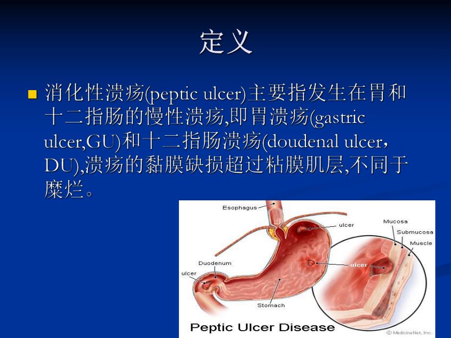 消化性溃疡.ppt_第3页