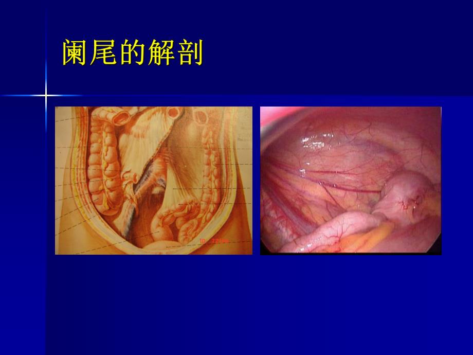 培训资料急性阑尾炎教学查房1.ppt_第2页