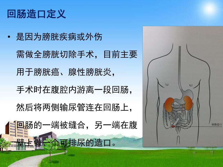 回肠造口出院健康指导.ppt_第2页