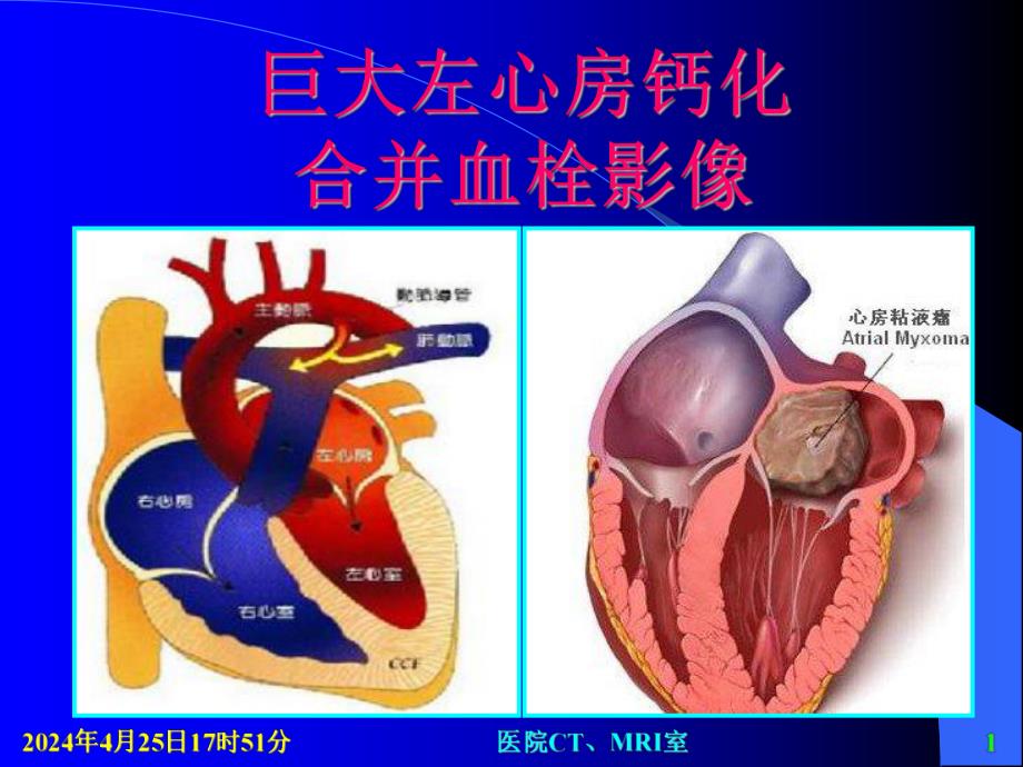 巨大左心房钙化合并血栓影像.ppt_第1页