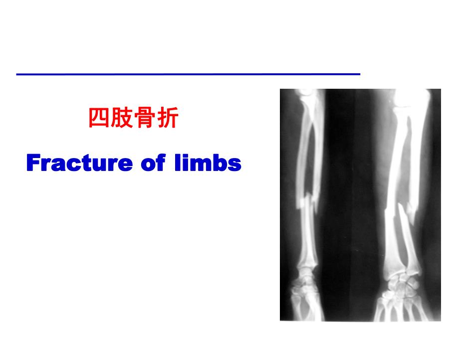 四肢骨折.ppt.ppt_第2页