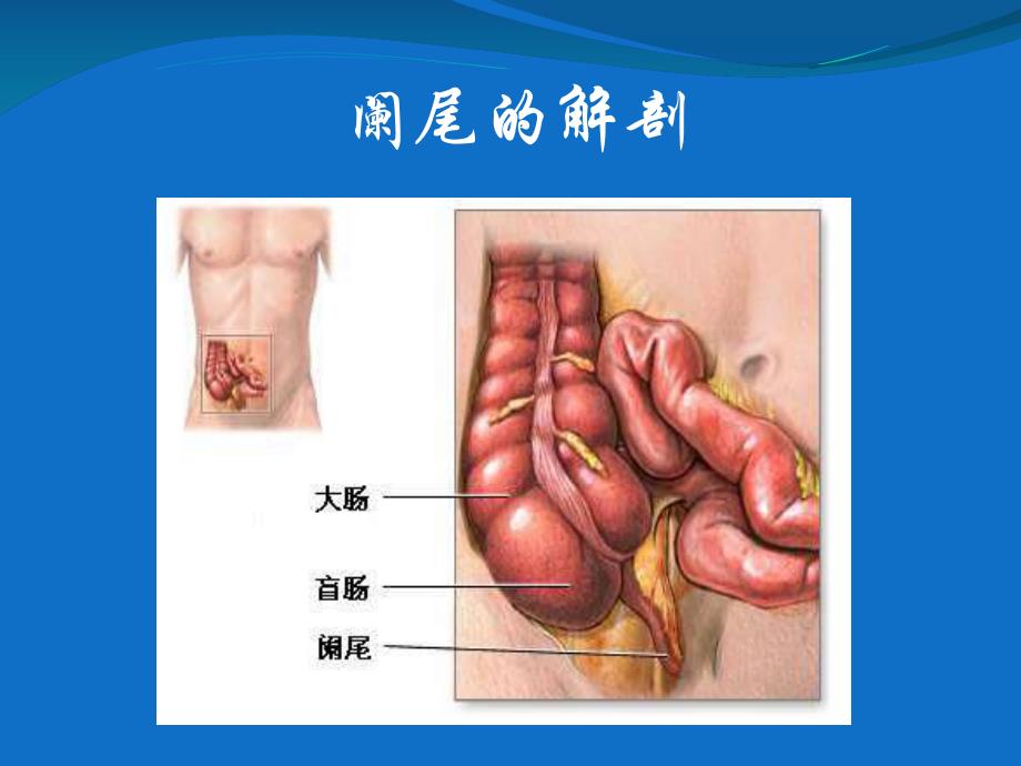 急性阑尾炎1.ppt_第3页