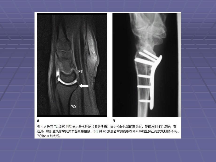 桡骨远端骨折..ppt_第3页