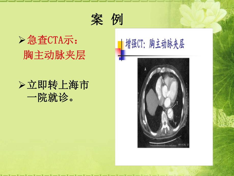 急诊降阶梯思维.ppt_第3页