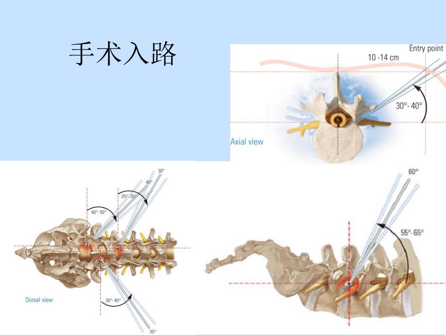 椎间孔镜手术操作方法.ppt_第3页