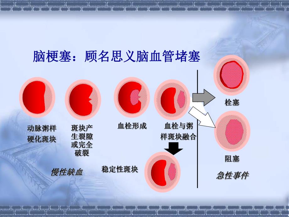 急性脑梗死超早期介入静脉溶栓的观察和护理.ppt_第3页