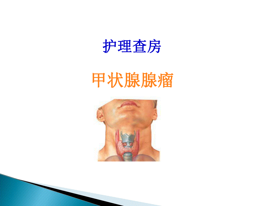 甲状腺腺瘤护理查房.ppt_第1页