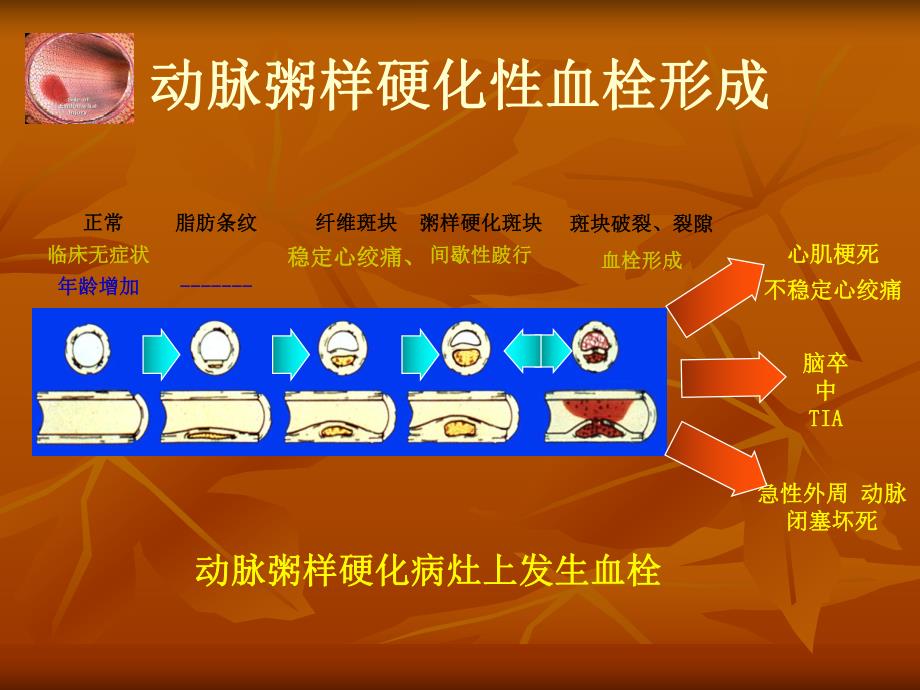 短暂性脑缺血发作2.ppt_第3页