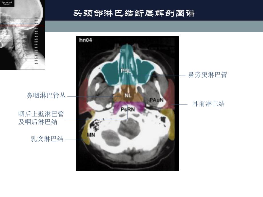 淋巴结断层解剖.ppt_第3页