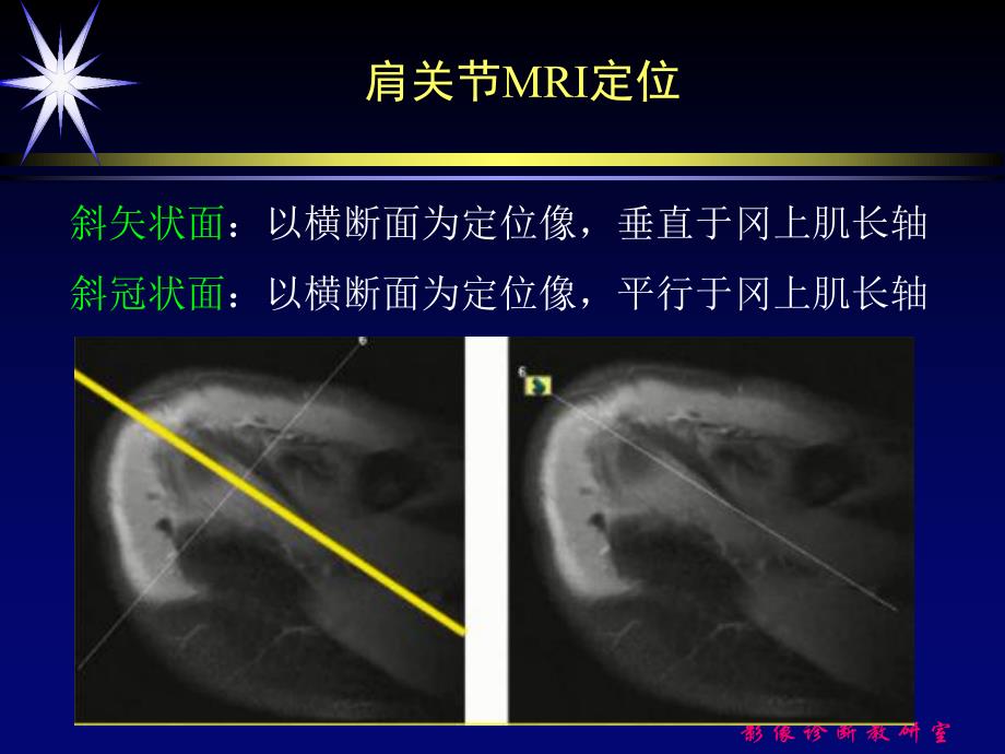 肩关节损伤的mri诊断图文.ppt_第3页