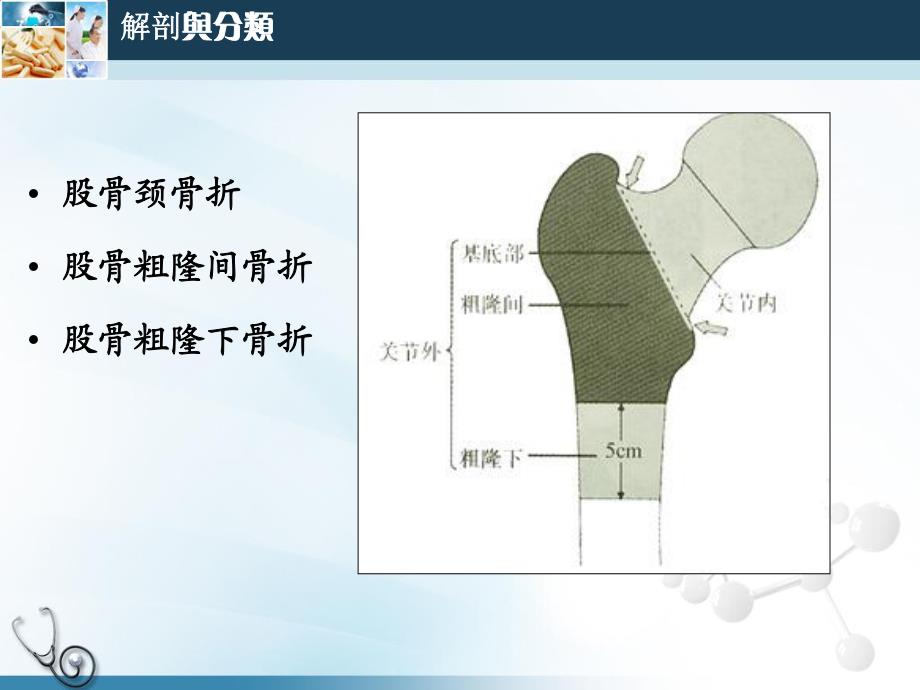 老股骨近端骨折的手术治疗.ppt_第2页