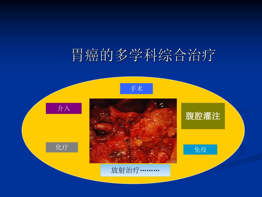 胃癌腹腔热灌注.ppt_第3页