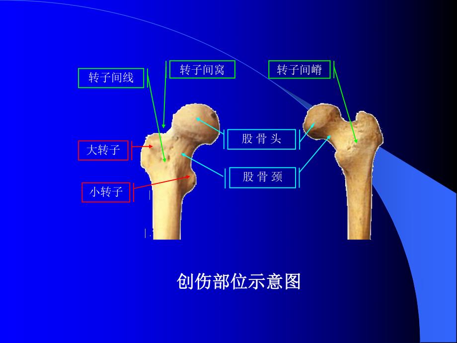 股骨转子间骨折.ppt_第3页