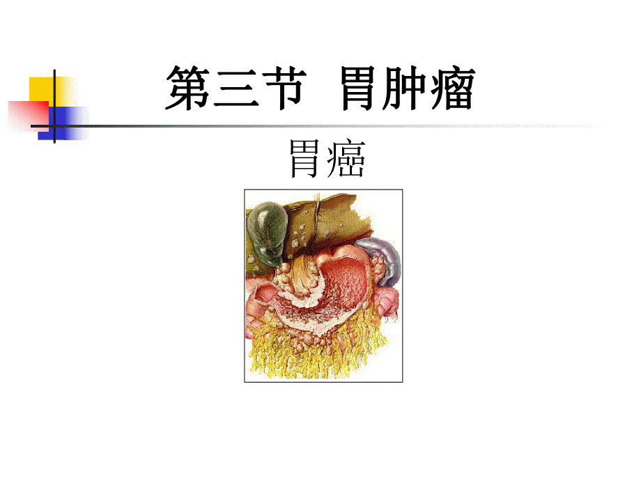 胃癌.ppt.ppt_第1页