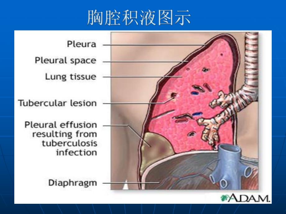 胸膜腔穿刺术.ppt_第3页