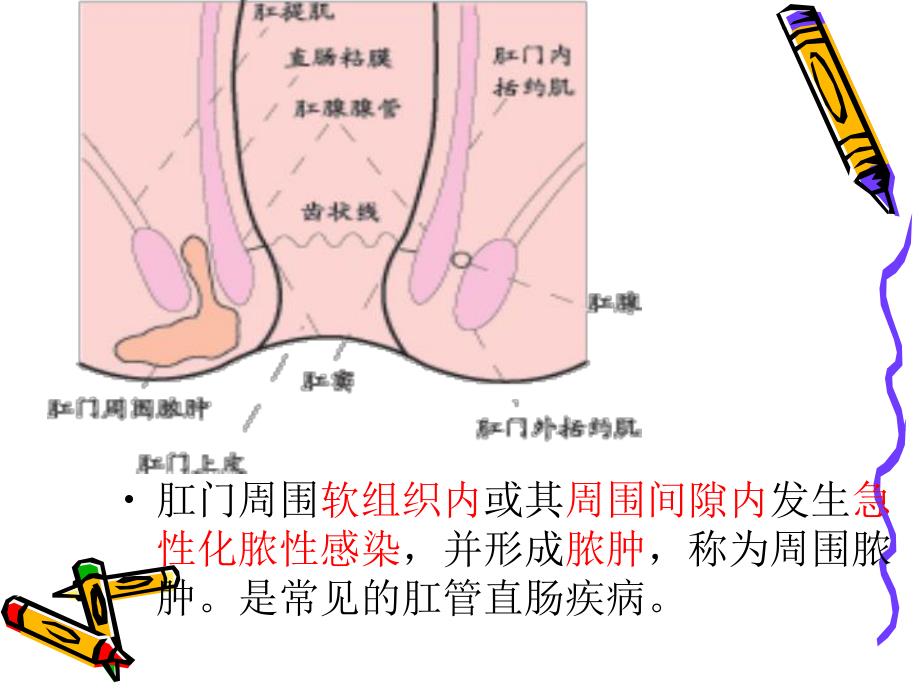 肛周脓肿.ppt_第3页