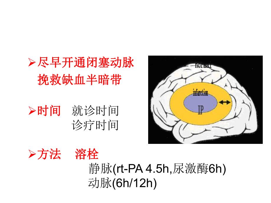 综合介入治疗急性缺血性脑卒中.ppt_第3页