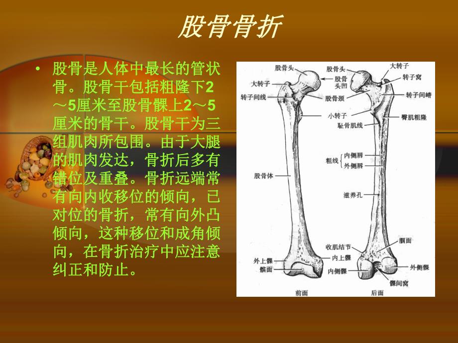 股骨干骨折护理查房.ppt_第3页