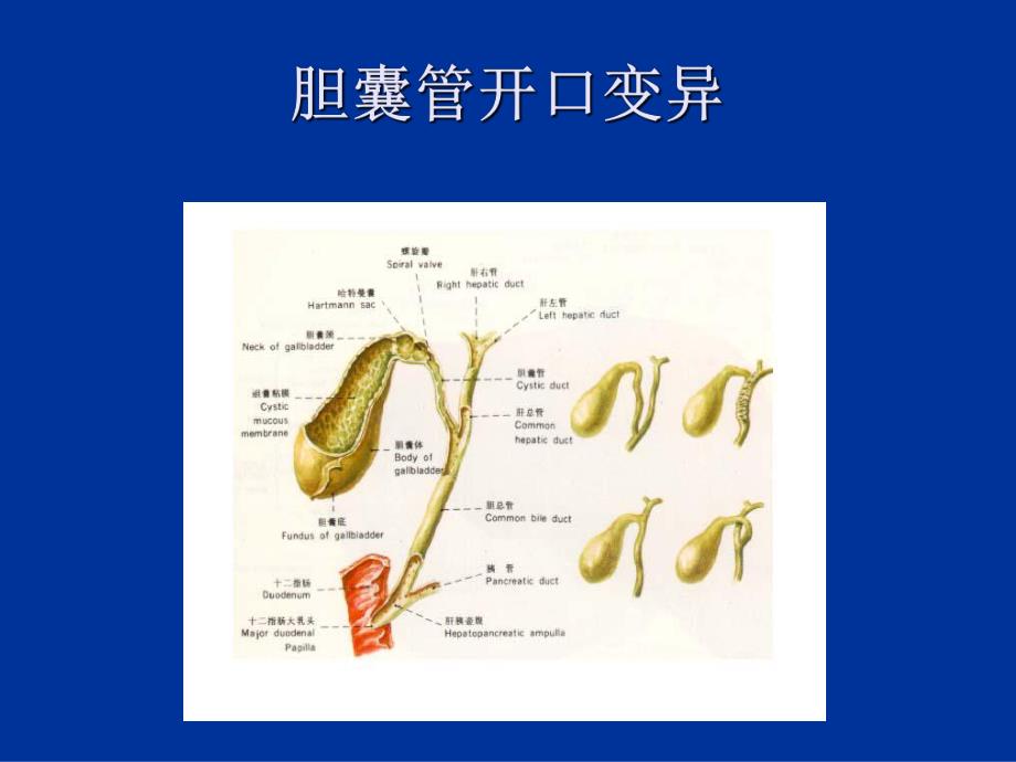 胆囊结石及防治.ppt_第3页