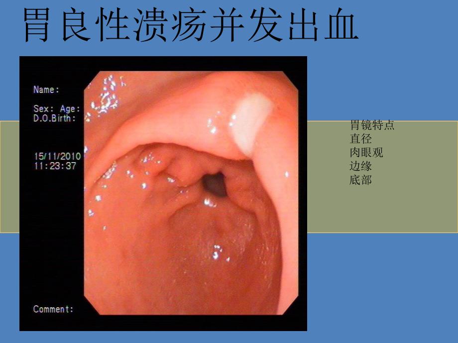 胃癌的鉴别诊断.ppt_第3页