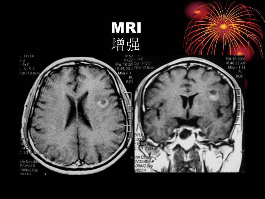 肿瘤样脱髓鞘病变影像特征以及鉴别诊断.ppt_第3页