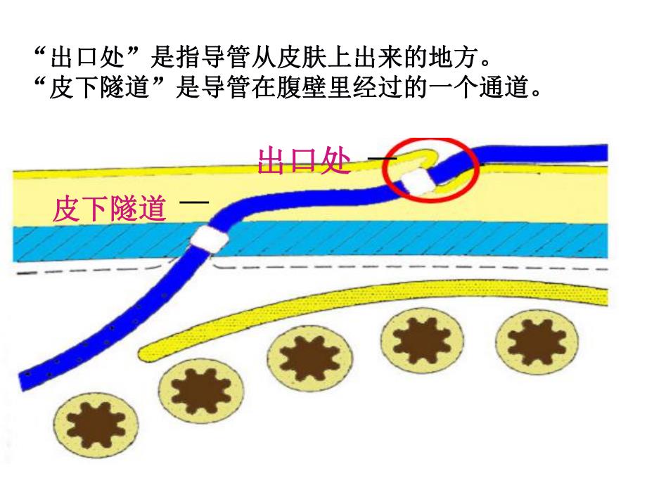 腹透导管出口处护理.ppt_第2页