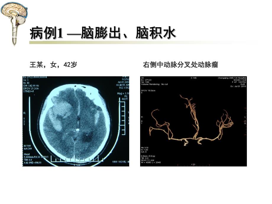 腰大池穿刺置管引流术.ppt_第2页