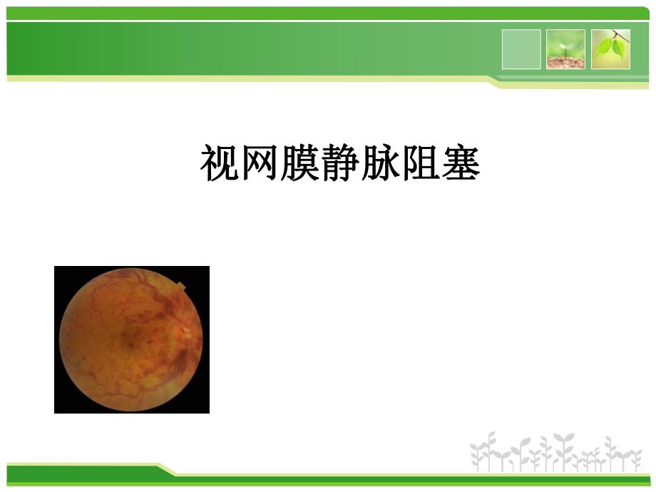 视网膜静脉阻塞.ppt_第1页