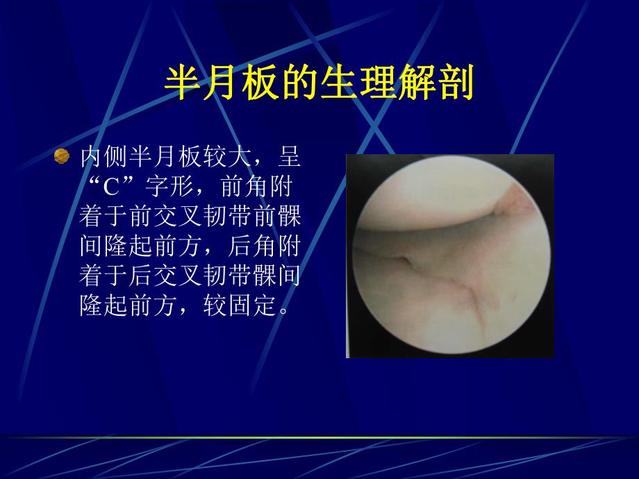 膝关节半月板损伤诊疗.ppt_第3页