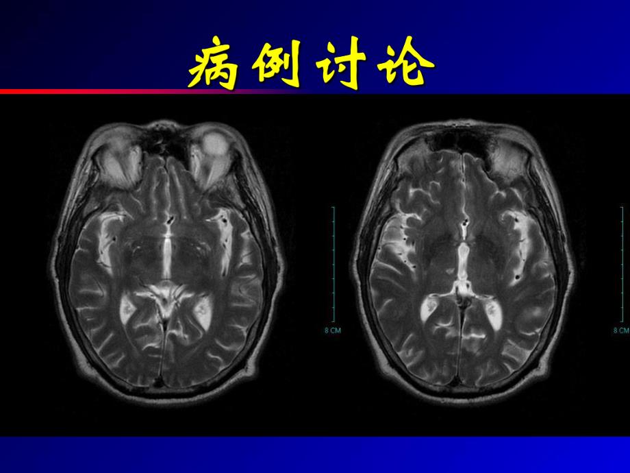 血管周围间隙.ppt_第2页