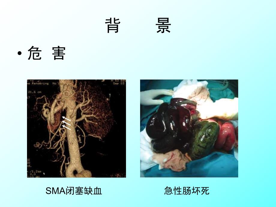 自发性孤立型肠系膜上动脉夹层影像学特征在治疗策略中的价值.ppt_第3页