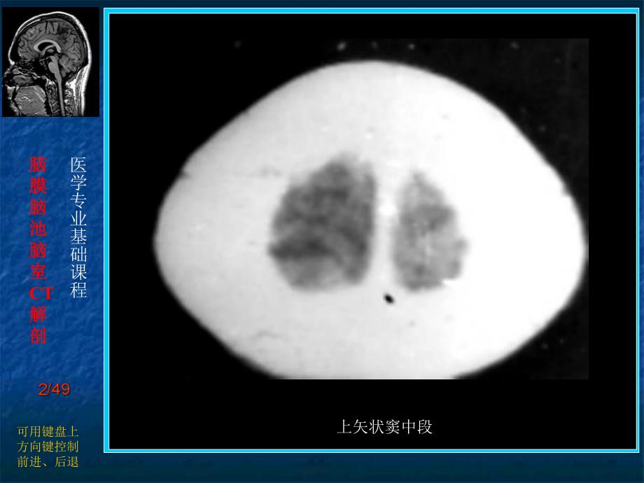 脑膜、脑池、脑室的CT解剖.ppt_第2页